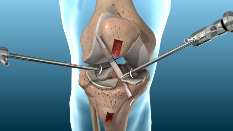acl_1280