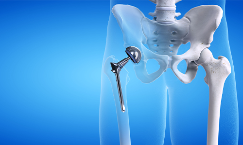 62af2d75314994085ab58294Hip-Replacement-Anterior-Approach